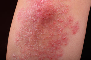 Psoriasis