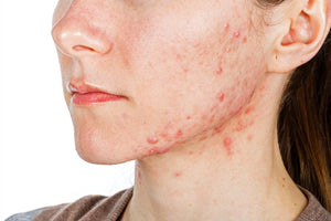 Vitamin B3 for acne